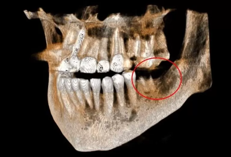 CBCT 3D fogászati CT